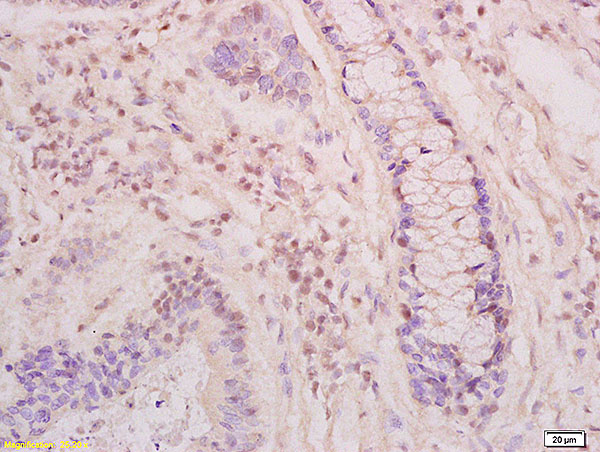 KLK6 Antibody (OABF01617) in Human colon carcinoma tissue using Immunohistochemistry