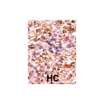 Phospho - Rb - S788 antibody (OAAB16110) in Human cancer, breast carcinoma, hepatocarcinoma using Immunohistochemistry