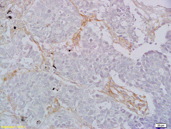 CD8A Antibody (OABF01480) in Human lung carcinoma using Immunohistochemistry
