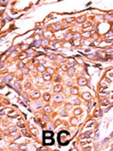 Phospho-cJun-S63 Antibody (OAAB16029) in human cancer tissue using immunohistochemistry