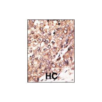 Bmp7 antibody - N - terminal region (OAAB12615) in Human cancer, breast carcinoma, hepatocarcinoma using Immunohistochemistry