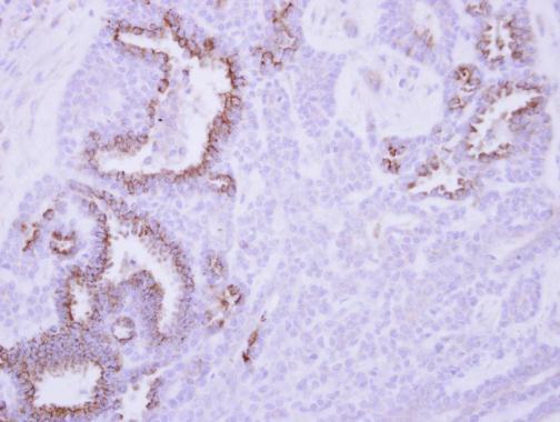 MCL1 Antibody (OAGA01794) in Paraffin-embedded Breast ca using Immunohistochemistry