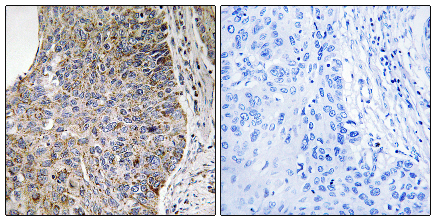 NEK7 Antibody (OAAF04244) in human lung carcinoma tissue using Immunohistochemistry.