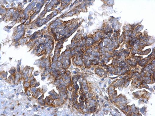CCR3 Antibody - C-terminal region (OAGA01253) in Human ovarian carcinoma using Immunohistochemistry