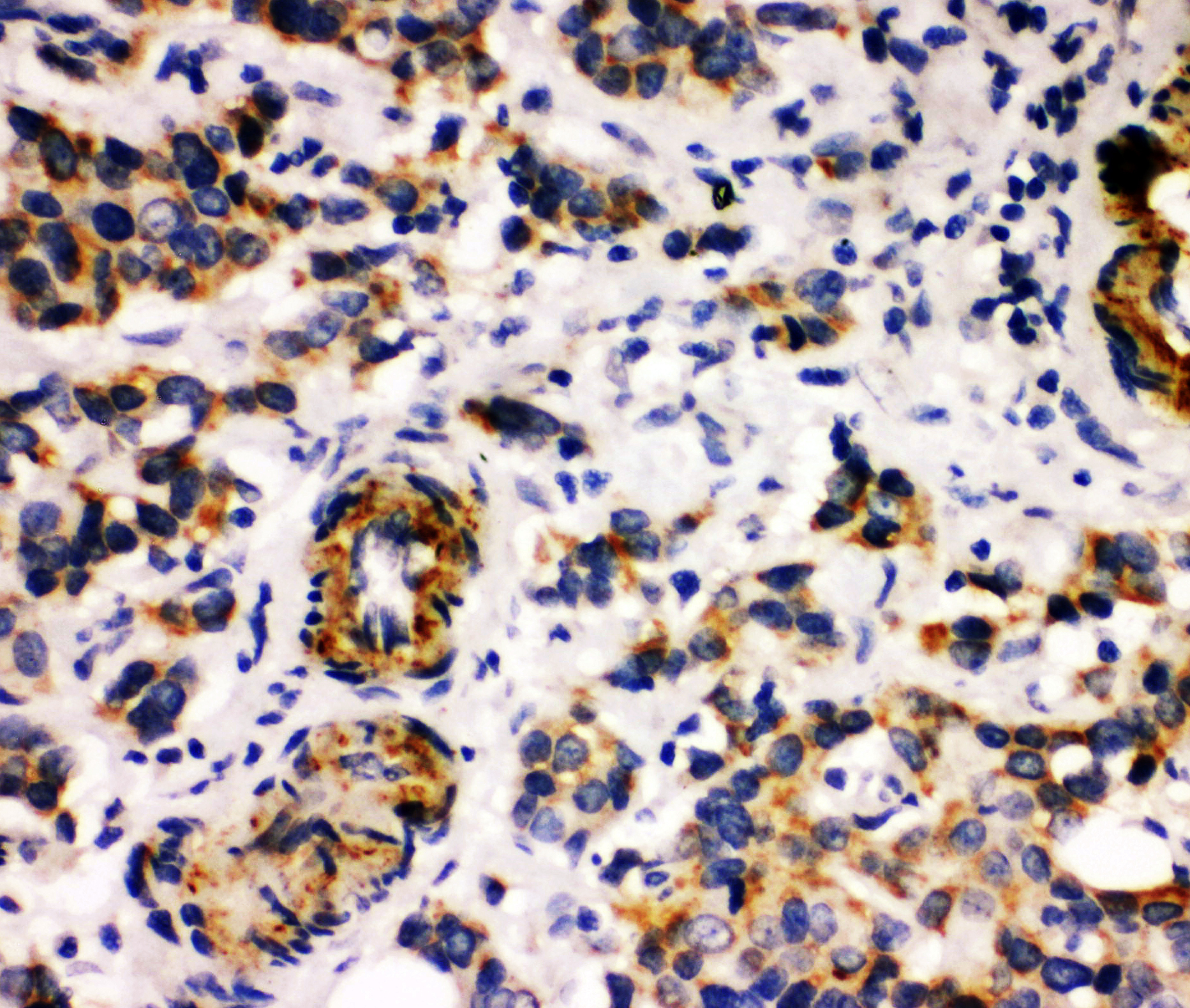 MFGE8 Antibody - middle region (OABB01092) in Human Mammary Cancer Tissue using Immunohistochemistry