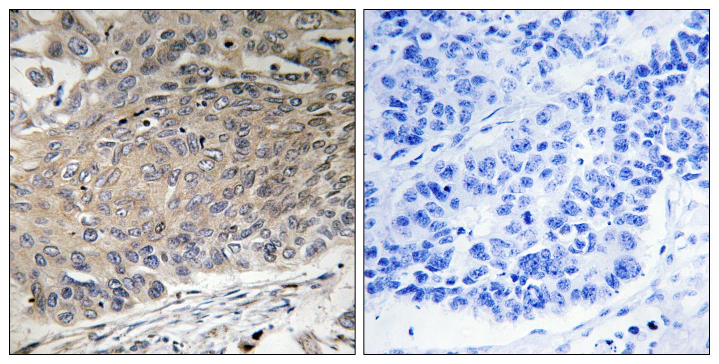DYNLL2 Antibody (OAAF03602) in human lung carcinoma tissue using Immunohistochemistry.