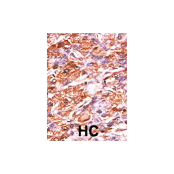 Phospho - Rb - S811 antibody (OAAB16112) in Human cancer, breast carcinoma, hepatocarcinoma using Immunohistochemistry