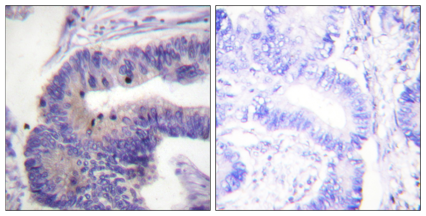 PDE4D Antibody (OAAF00816) in human colon carcinoma tissue using Immunohistochemistry.