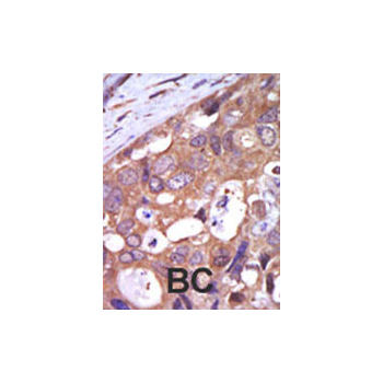 PKC mu antibody - N - terminal region (OAAB16755) in Human cancer, breast carcinoma, hepatocarcinoma using Immunohistochemistry
