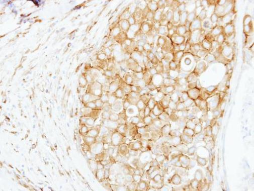 CTTN Antibody - N-terminal region (OAGA01221) in Paraffin-embedded Breast ca using Immunohistochemistry