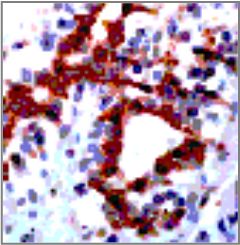 Rabbit Anti-FGFR-3 Antibody (OAAI00009) in Human Breast carcinoma using Immunohistochemistry.