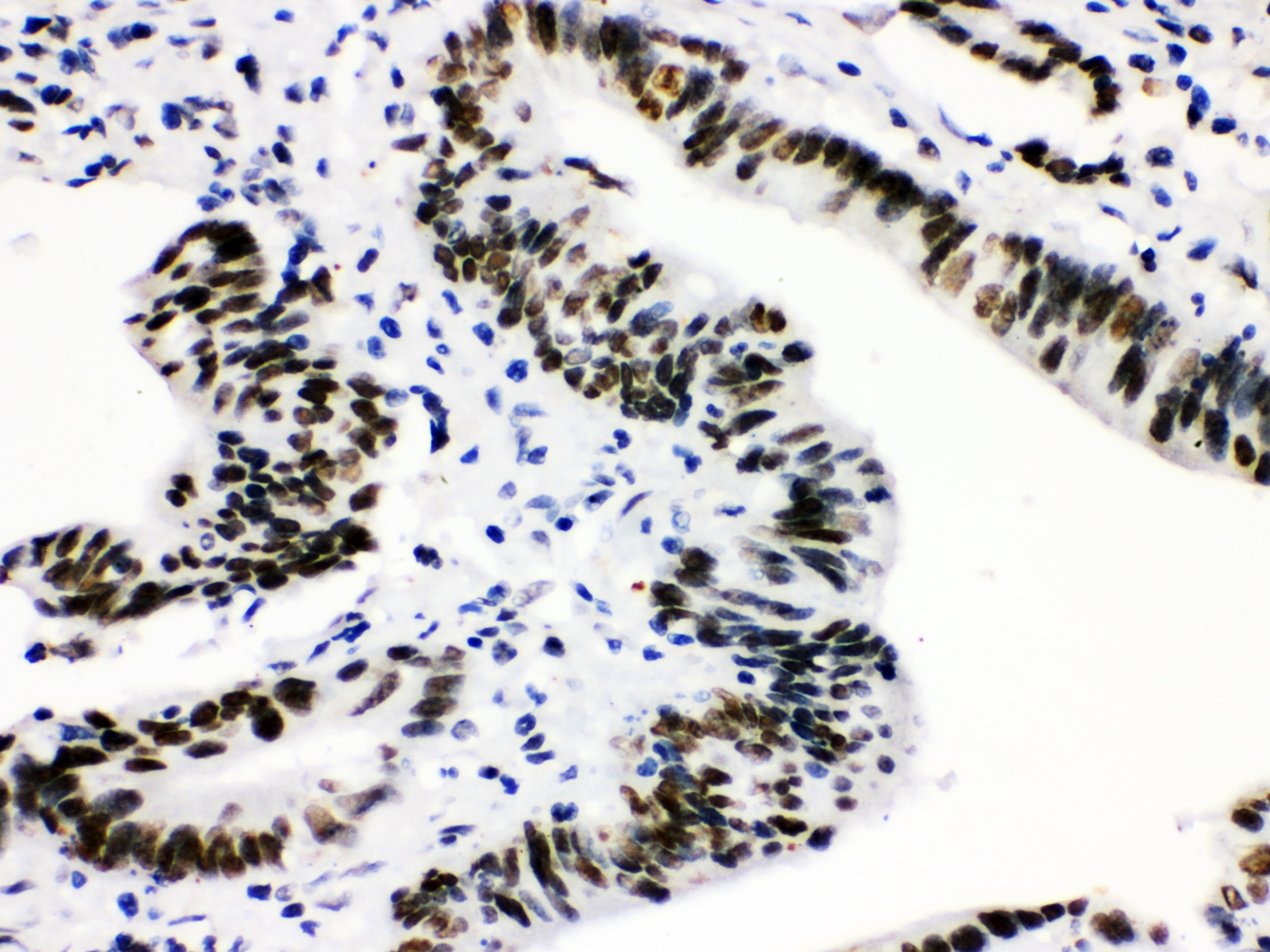 CTBP2 Antibody (OABB01909) in Human Intestinal Cancer Tissue using Immunohistochemistry