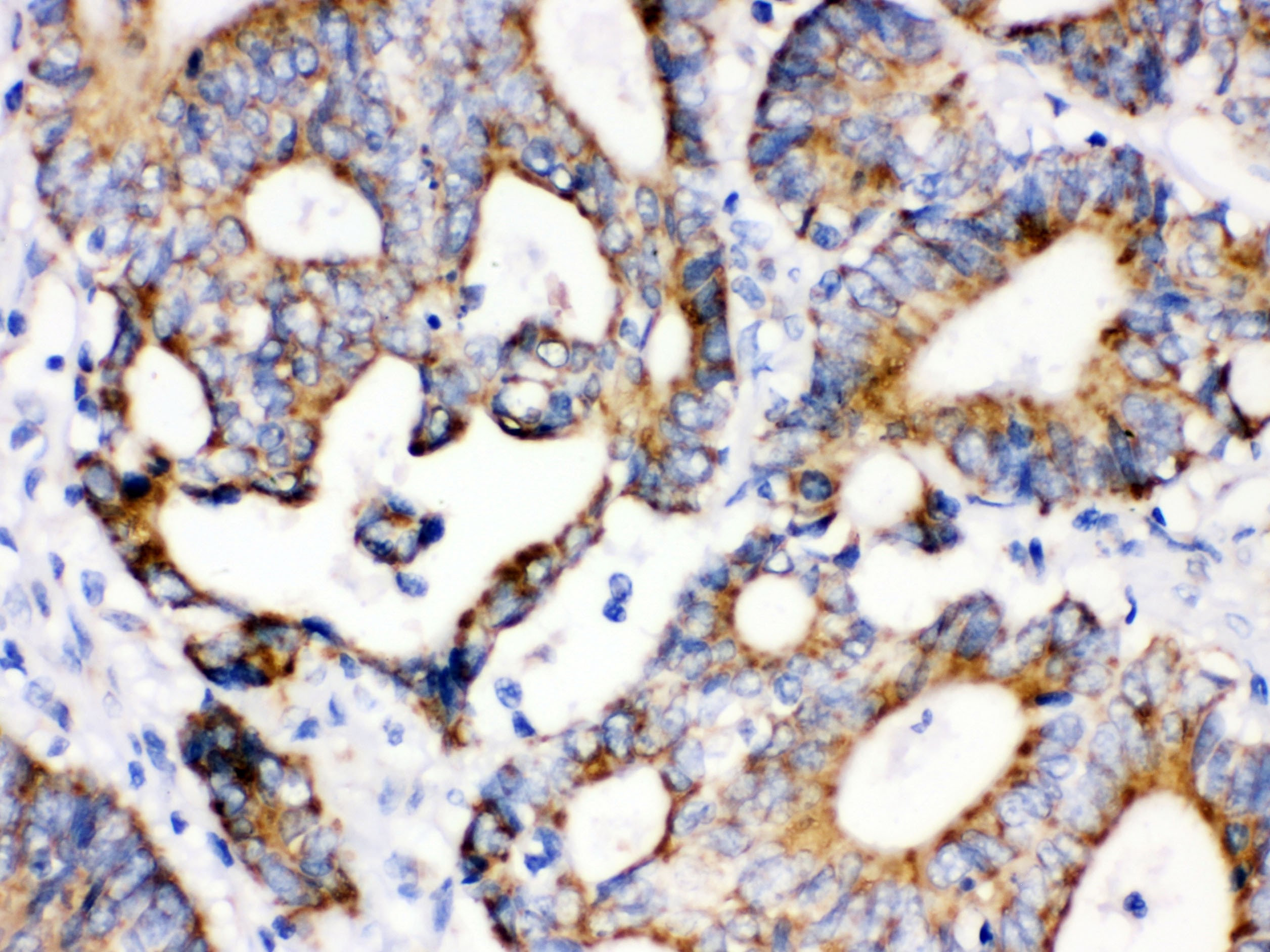 IDH2 Antibody - C-terminal region (OABB02085) in Human Intestinal Cancer Tissue using Immunohistochemistry