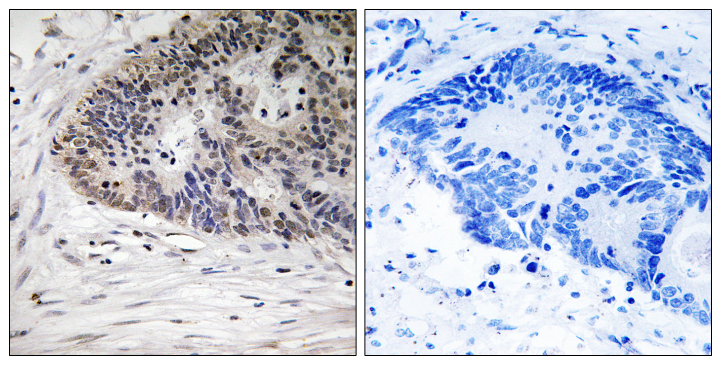 MDM4 Antibody (Phospho-Ser367) (OAAB20479) in Human Colon Carcinoma Cells using Immunohistochemistry