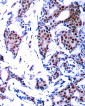 JUN Antibody (Phospho-Ser73) (OAAN02763) in Human Breast using Immunohistochemistry