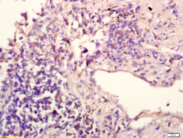 IL12RB1 Antibody (OAAB21853) in Human Lung Carcinoma Cells using Immunohistochemistry