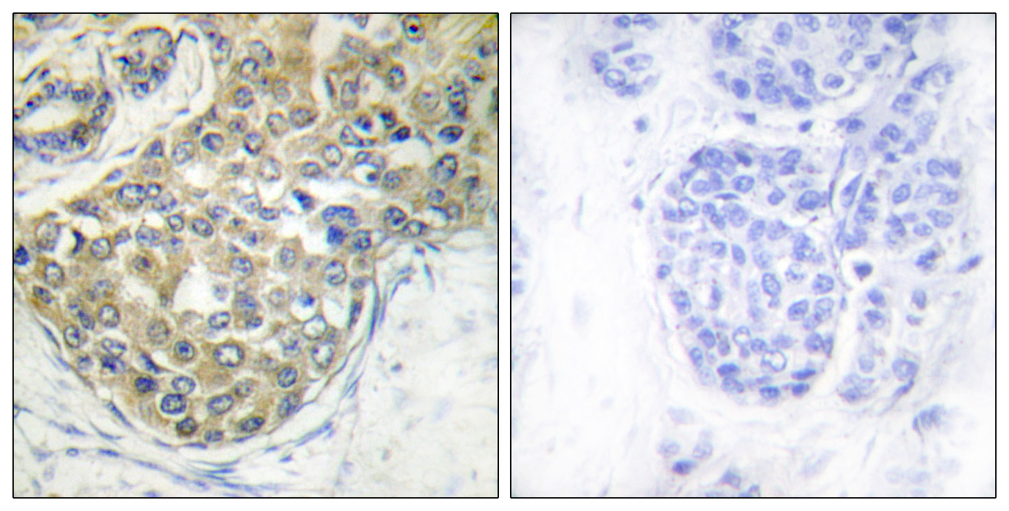 TNK2 Antibody (Phospho-Tyr284) (OAAB20039) in Human Breast Carcinoma Cells using Immunohistochemistry