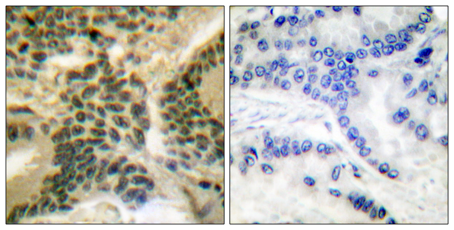 PRKCZ Antibody (Phospho-Thr410) (OAAB20621) in Human Lung Carcinoma Cells using Immunohistochemistry
