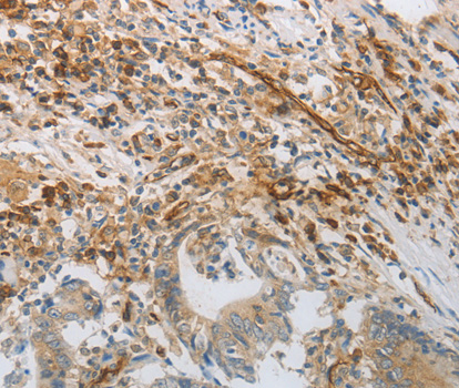PECAM1 Antibody (OAAN01084) in Colon Cancer using Immunohistochemistry