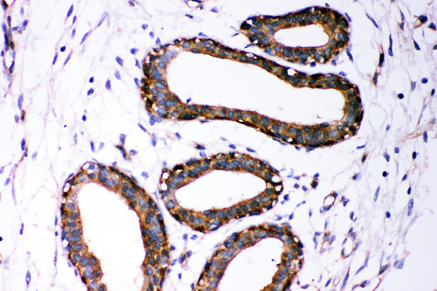 DICER1 Antibody (OABB00929) in Human Mammary Cancer Tissue using Immunohistochemistry