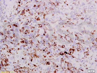 PRAME黑色素瘤优先表达抗原抗体