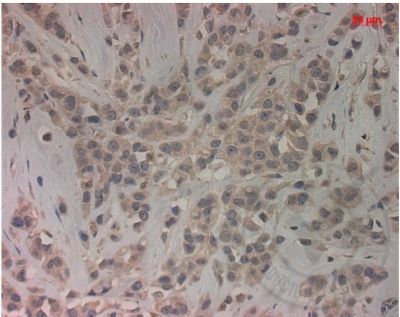 PALB2乳腺癌易感基因相关蛋白2