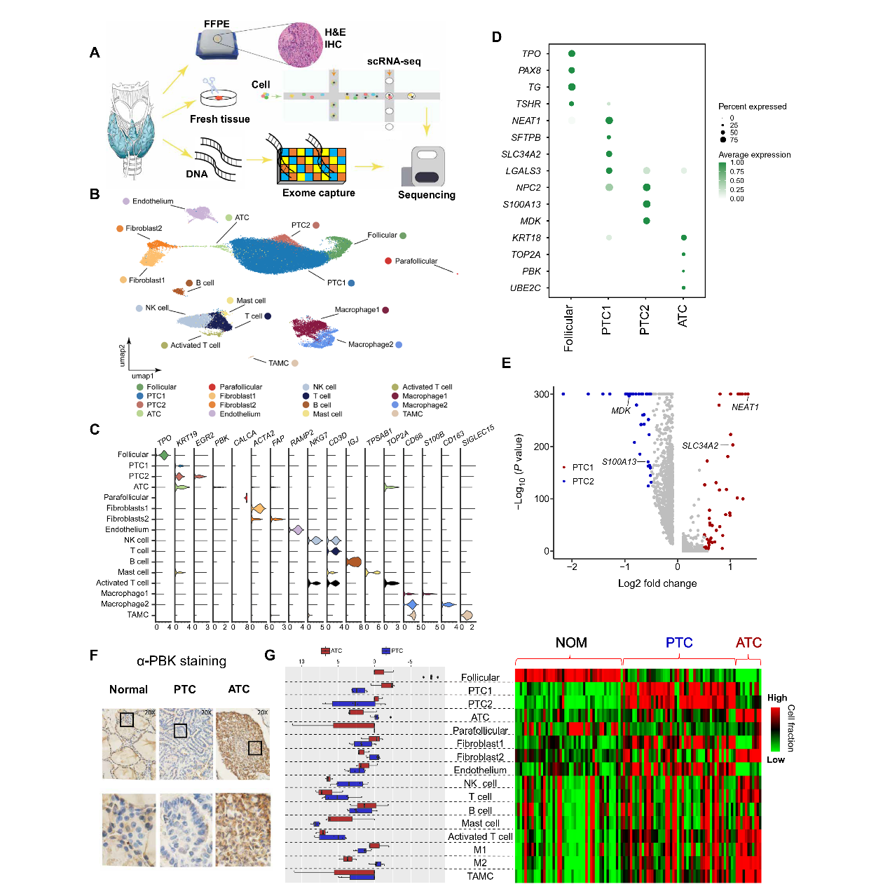 文献解读｜甲状腺癌去分化的综合分析