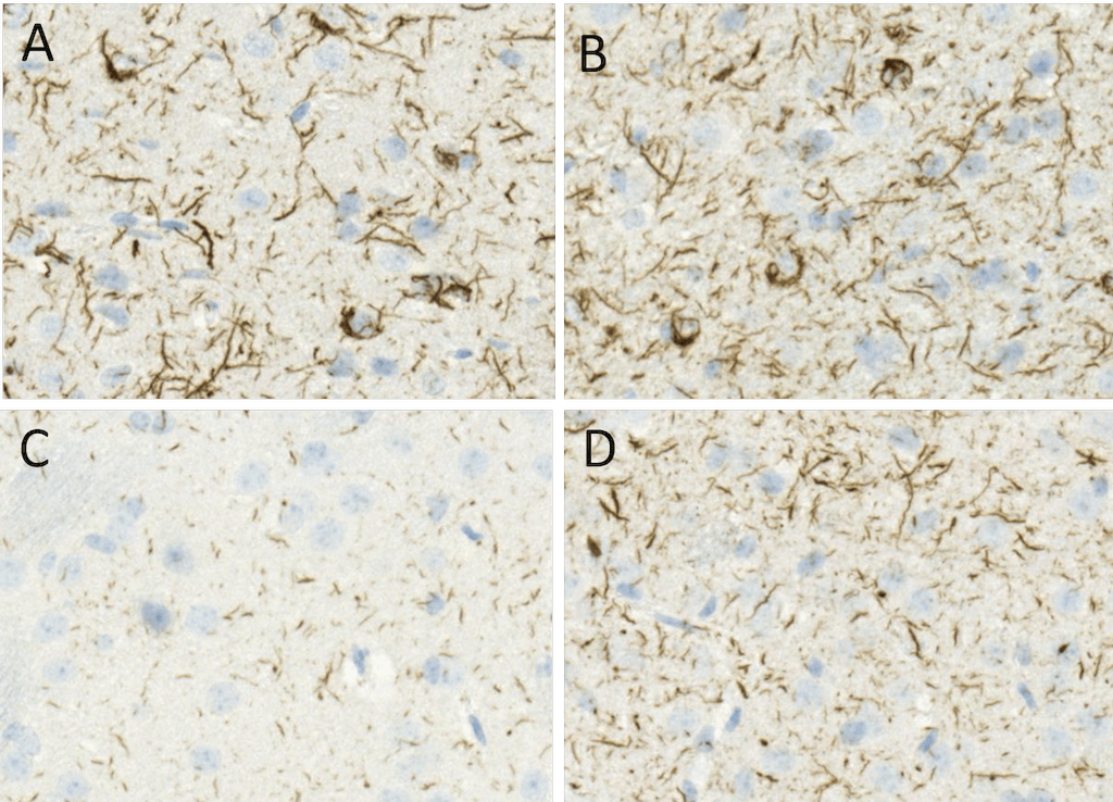 Alpha Synuclein 蛋白前体原纤维Pre-for