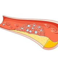 动脉粥样硬化小鼠模型