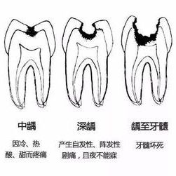 动物实验丨龋齿动物模型