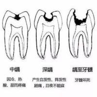 动物实验丨龋齿动物模型