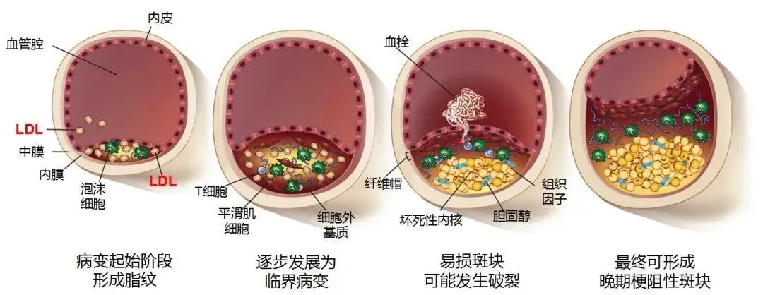 ApoE KO小鼠制作动脉粥样硬化模型 - 企业动态 - 丁香通