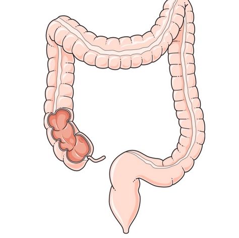 慢性结肠炎模型