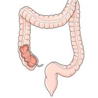 慢性结肠炎模型