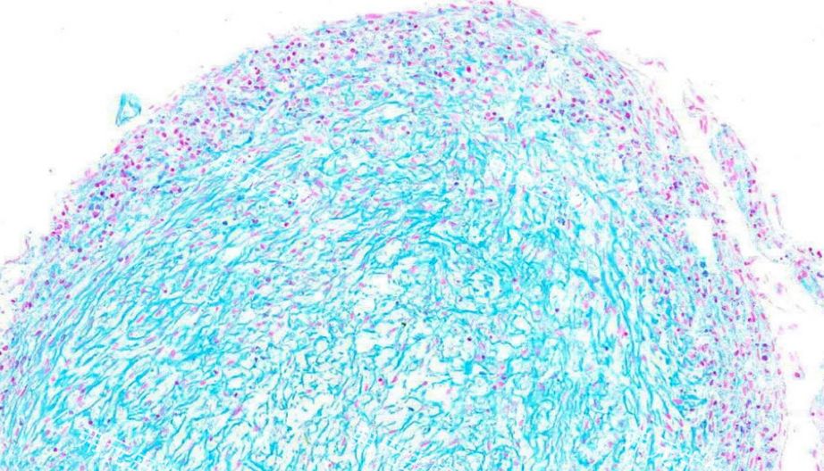 间充质干细胞成软骨诱导注意事项