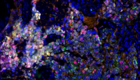 深入肿瘤微环境 | 揭秘癌症生长的隐秘角落