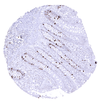 Topoisomerase 2-alpha / TOPO2A