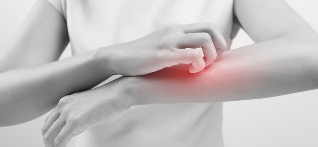 探秘特应性皮炎小鼠模型：药物评估与科学研究的得力助手！