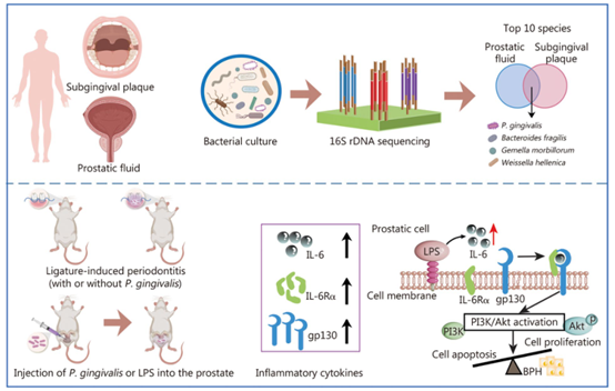 牙龈卟啉单胞菌通过IL-6/IL-6R加剧良性前列腺增生