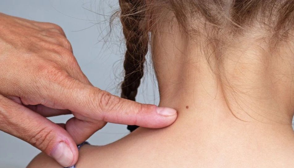 警惕皮肤上的“隐秘信号”：黑痣与黑色素瘤