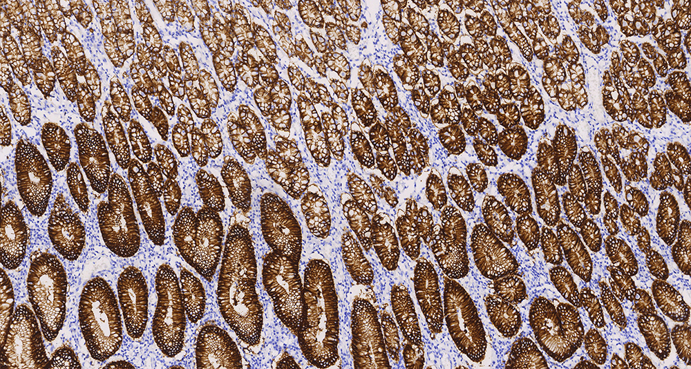 “靶”向“胃”来，Claudin18.2熠熠生辉，单抗、双抗、CAR-T、ADC蓄势待发