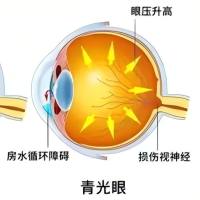 动物造模丨高眼压与青光眼动物模型