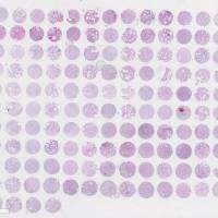 生存期前列腺癌组织芯片