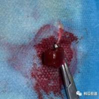 大鼠肾部分切除致肾衰竭模型