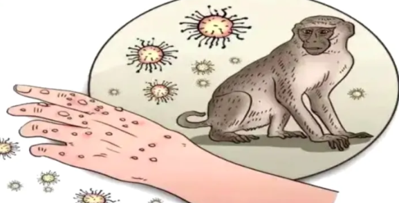 RD如何应对猴痘？