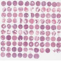 乳腺癌组织芯片BRC2281