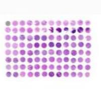 淋巴瘤组织芯片