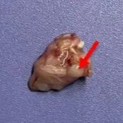 裸鼠胰腺癌原位移植瘤模型