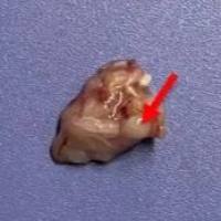 裸鼠胰腺癌原位移植瘤模型