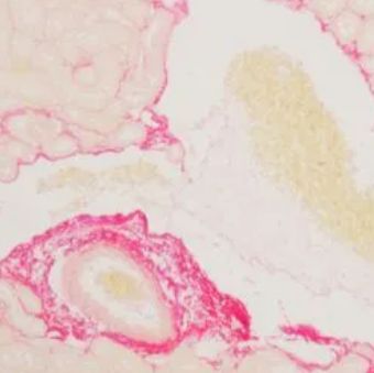 天狼猩红染色（实验代测）